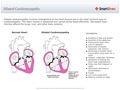 Dilated_Cardiomyopathy