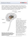 Parkinson's_Disease