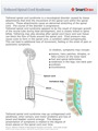Tethered_Spinal_Cord_Syndrome