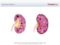 Polycystic_Kidney