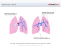 Pulmonary_Emboli