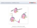 Catheter_Introduction,_Umbilical_Artery