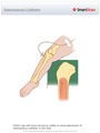 Interosseous_Catheter