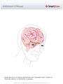 Alzheimer's_Disease