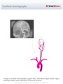 Cerebral_Arteriography