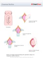 Cesarean_Section